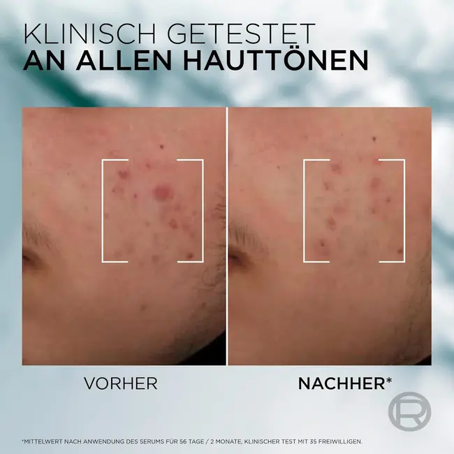 L'ORÉAL PARiS MEN EXPERT Derma Control Anti-Blemish Serum 30ml