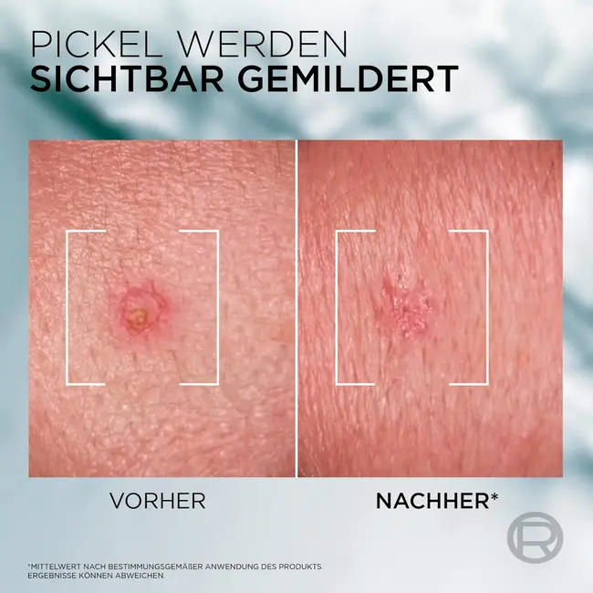 L'ORÉAL PARiS MEN EXPERT Anti Puistjes Crème SOS Derma Control 45.0 ml