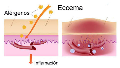 Consejos sobre el tratamiento del eccema