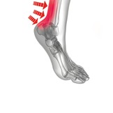Inlegzolen Achilles Klachten Heren