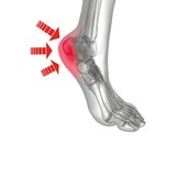 Inlegzolen Hielspoor Klachten Dames