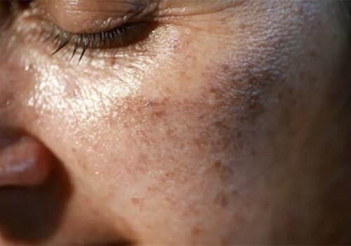 Hyperpigmentation Hyperpigmentation