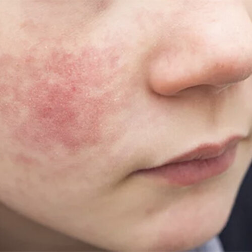 Eczema