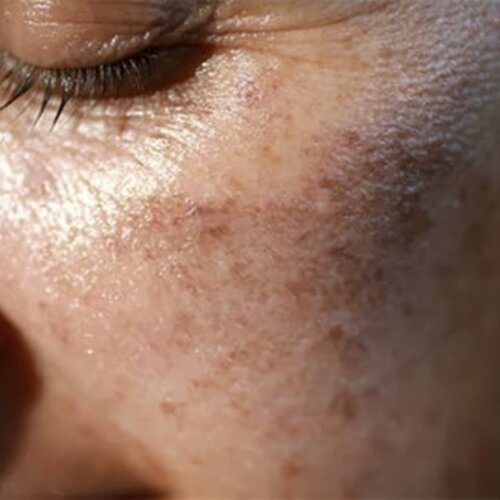 Hyperpigmentation