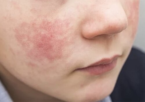 Dermatitis / Eccema Dermatitis / Eccema