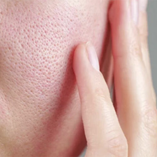 Pore Care