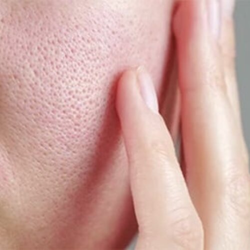 Soins des pores