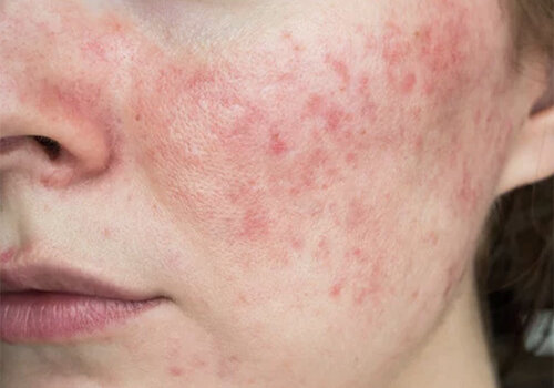 Rosacea / Hives Rosacea / Hives