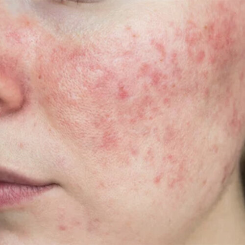 Rosacea / Hives