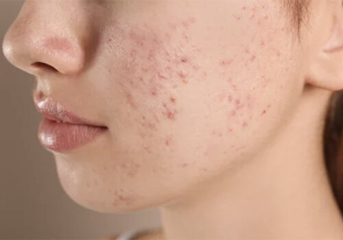 Acne Acne