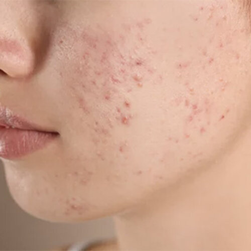 Acne