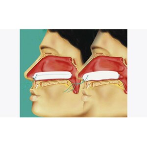 Lohmann & Rauscher L&R Raucocel Rechte Neustamponnade