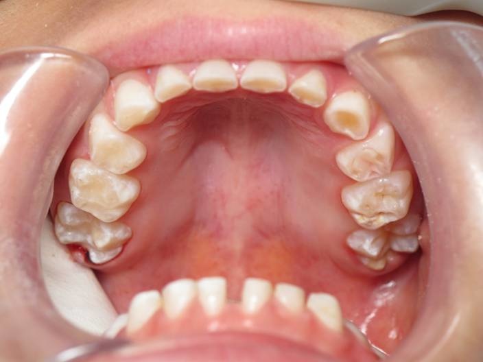 schade en slijtage bij tandenknarsen