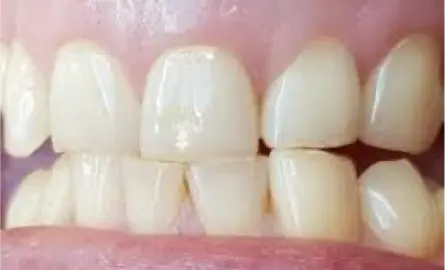 7 Bewezen tips om tandenknarsen en klemmen te stoppen