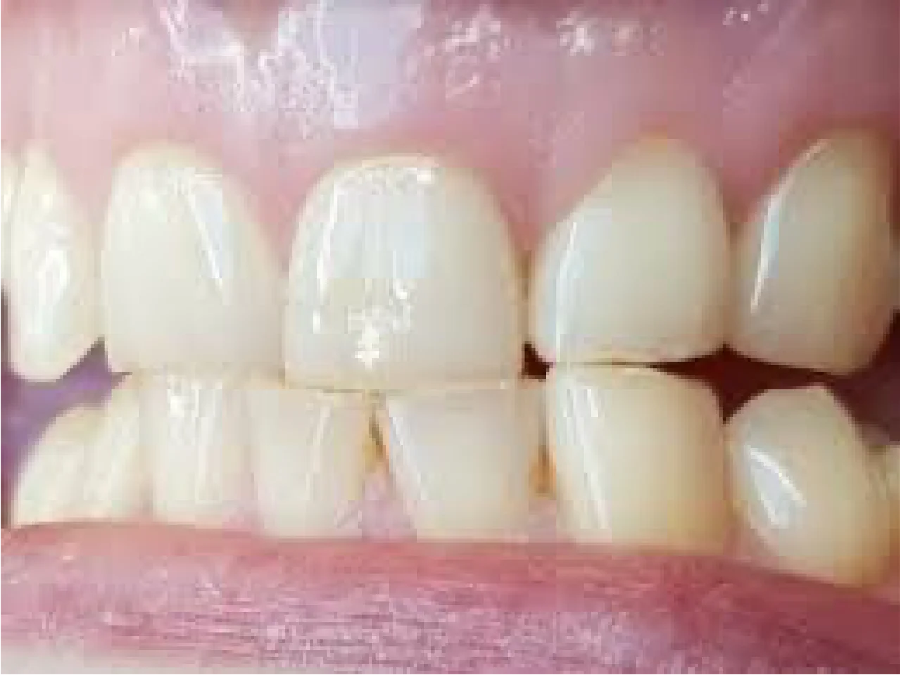 7 Bewezen tips om tandenknarsen en klemmen te stoppen 7 Bewezen tips om tandenknarsen en klemmen te stoppen