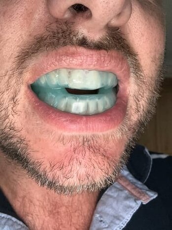 SleepPro Custom Snurkbeugel op Maat