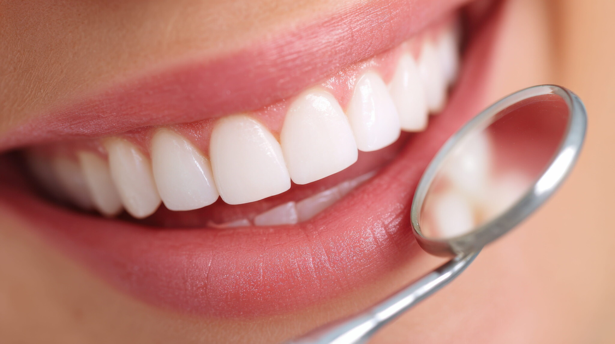 Wat zijn de voor- en nadelen van tanden bleken?