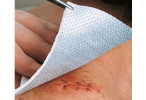 Metalline nw kompres 8 x 10 cm steriel