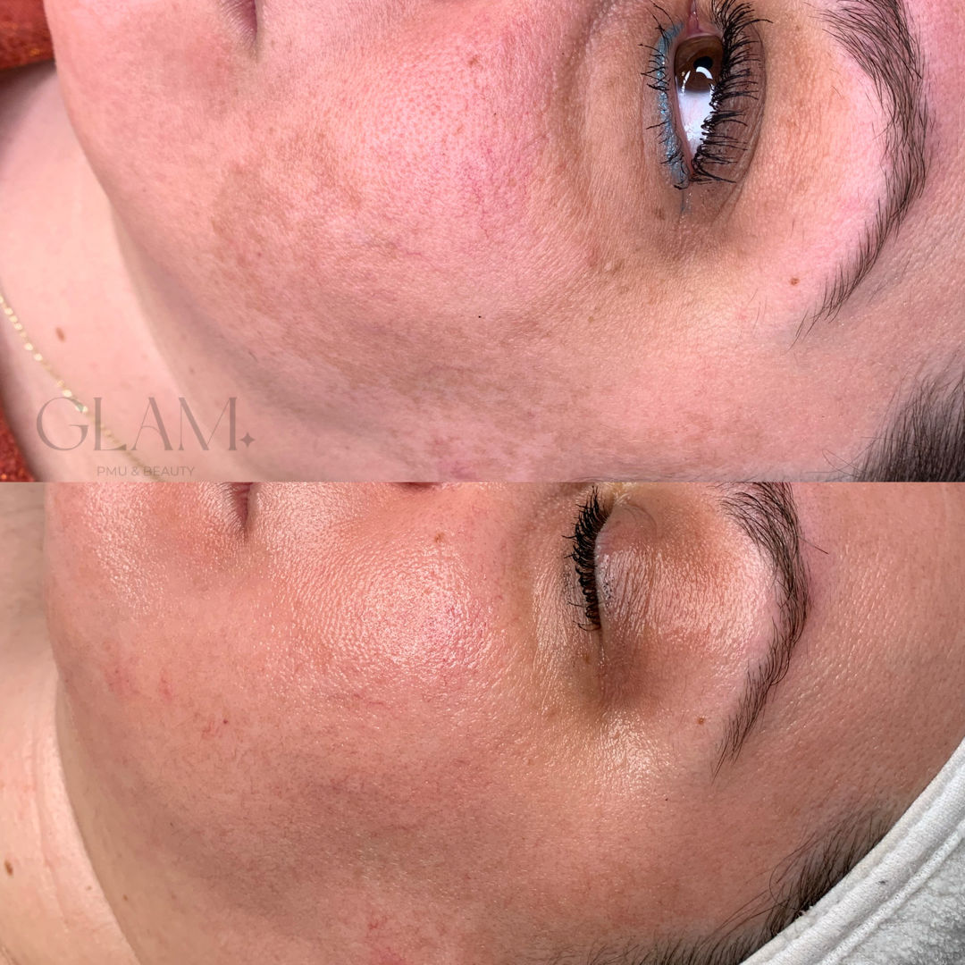 cosmelan treatment against pigmentation spots