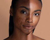 Taches brunes et hyperpigmentation: tout ce qu’il faut savoir