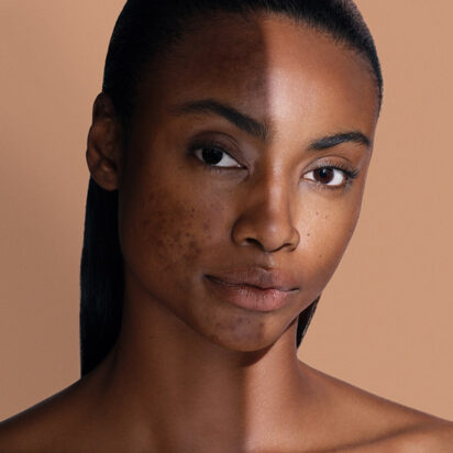 Taches brunes et hyperpigmentation: tout ce qu’il faut savoir Taches brunes et hyperpigmentation: tout ce qu’il faut savoir