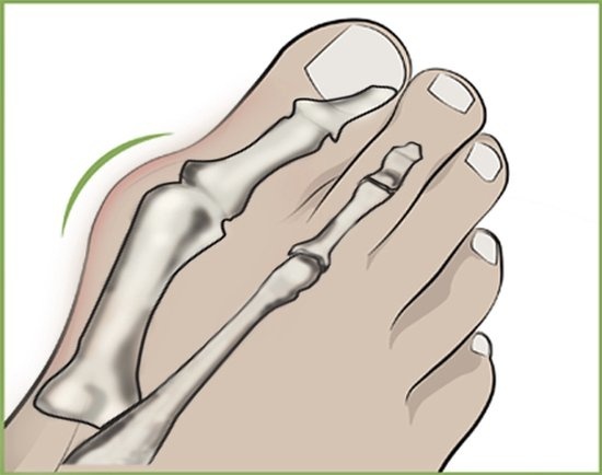 Hallux Valgus günstig Kaufen-Hallux Valgus Zehenspreizer. Hallux Valgus Zehenspreizer <![CDATA[Entlastet Druck und Beschwerden Unterstützt die Behandlung gegen Hallux valgus Trägt zu einem angenehmen Tragekomfort im Schuh bei Medizinprodukt Klasse 1 Der Zehenspreizer hat ein besond