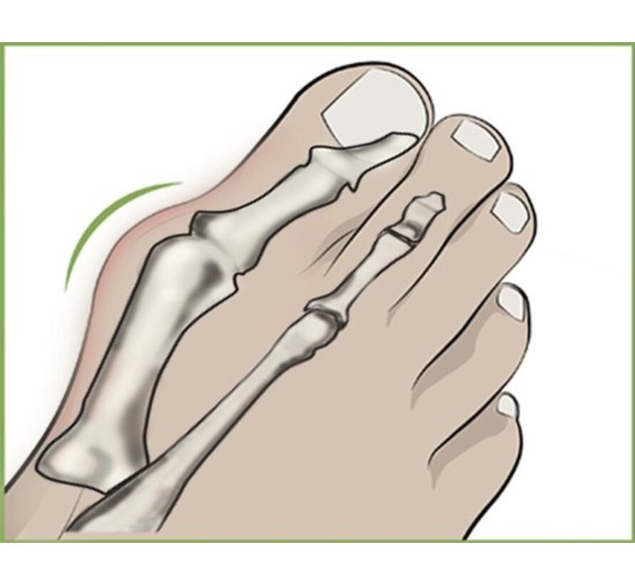 Generic - Écarteur d'orteil Hallux Valgus