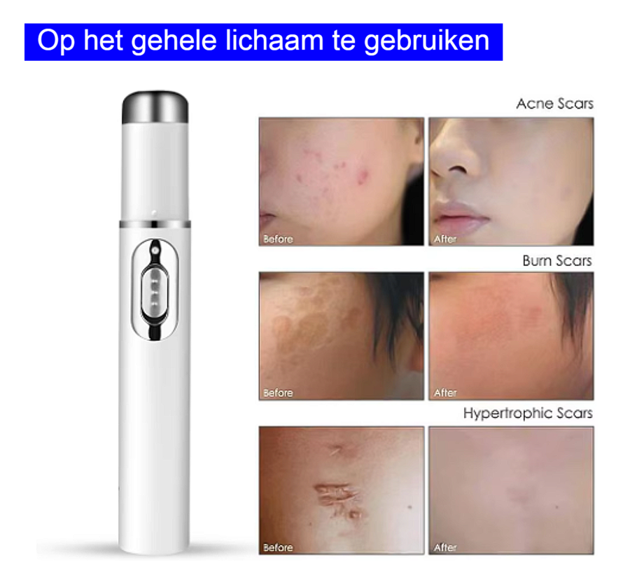 Allernieuwste.nl® Blauwe Licht Gezicht Laserpen - Acne & Rimpel Verwijdering + Huidverjonging ##