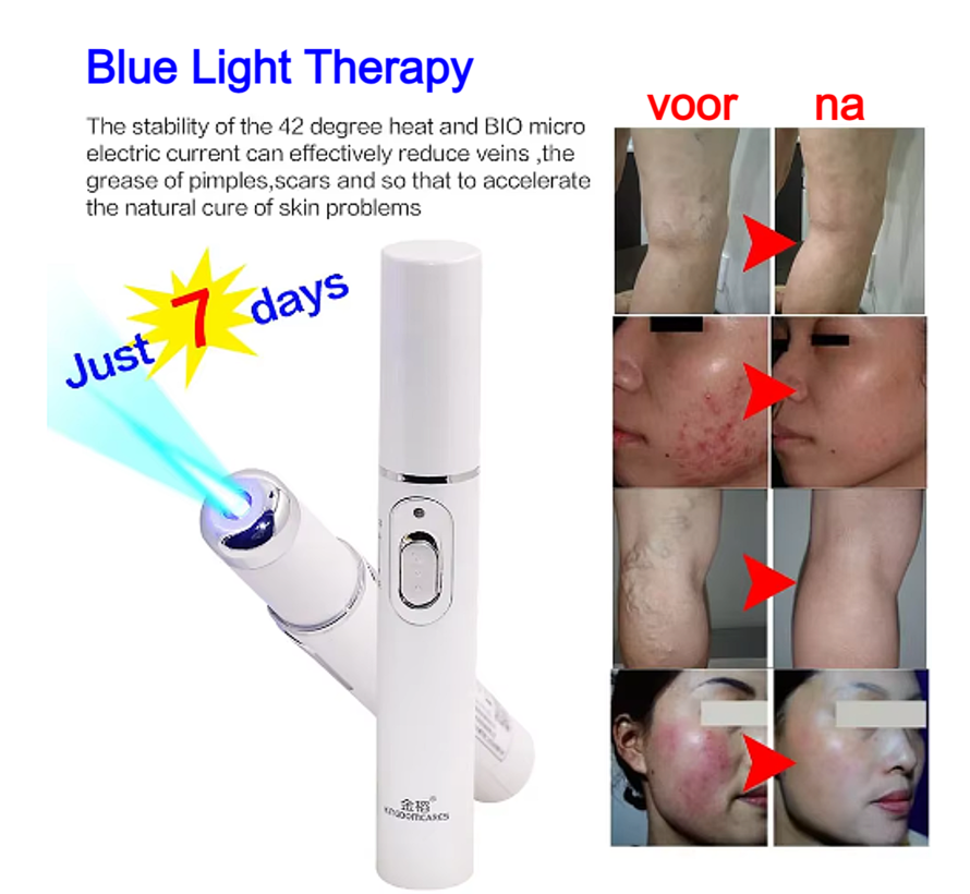 Allernieuwste.nl® Blauwe Licht Gezicht Laserpen - Acne & Rimpel Verwijdering + Huidverjonging ##