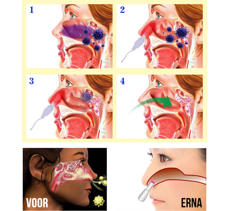 Rhinitis Sinusitis Fototherapie Neus Apparaat - Hooikoorts - Draagbaar - Pollenbestrijding - ***WORDT DEZELFDE DAG NOG VERZONDEN VOOR 17:00UUR**