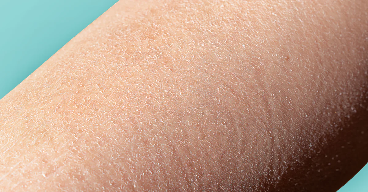 Waarom een goede bodylotion belangrijk is