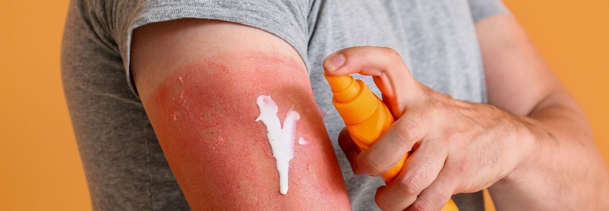 Waarom zonnebrand zo belangrijk is