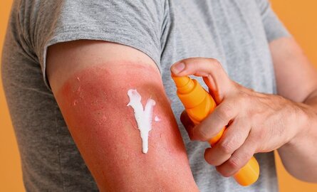 Waarom zonnebrand zo belangrijk is