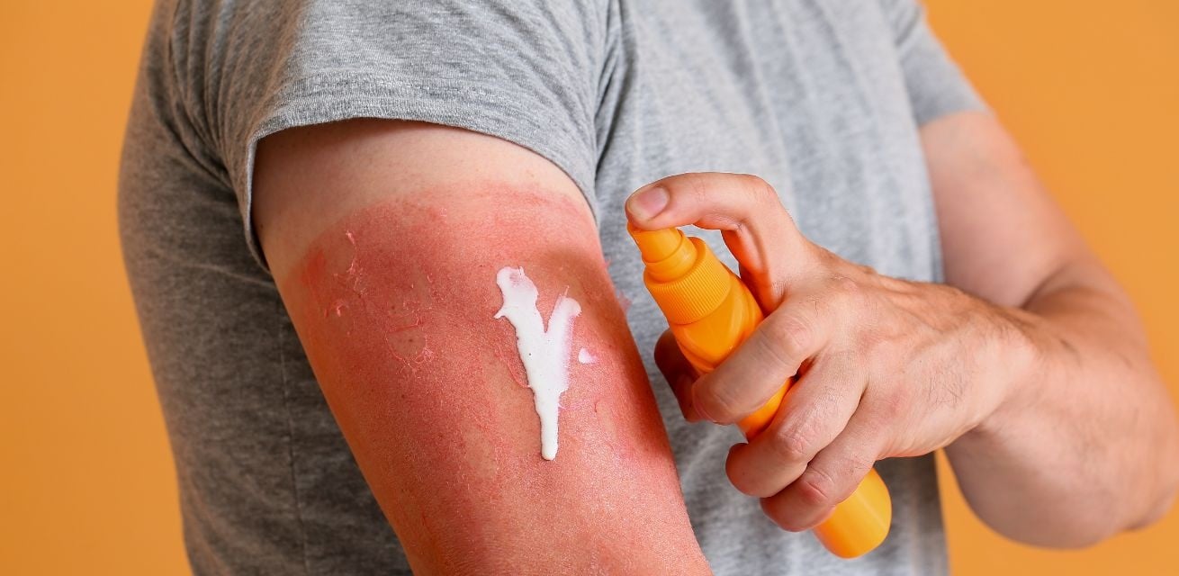 Waarom zonnebrand zo belangrijk is