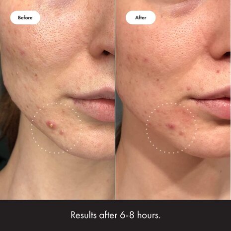 Hero Cosmetics Hero Cosmetics Mighty Patch Invisible Hero Cosmetics Hero Cosmetics Mighty Patch Invisible