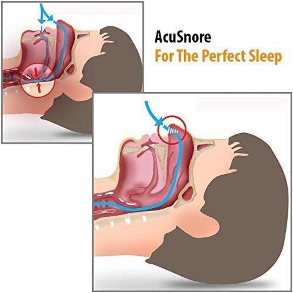Acusnore Acusnore Air Flow Nose Vents - Single Pack - Extra Small Acusnore Acusnore Air Flow Nose Vents - Single Pack - Extra Small