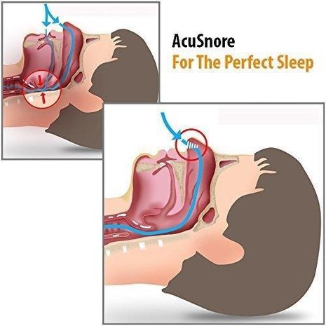 Acusnore Acusnore Air Flow Nose Vents - Single Pack - Extra Small Acusnore Acusnore Air Flow Nose Vents - Single Pack - Extra Small