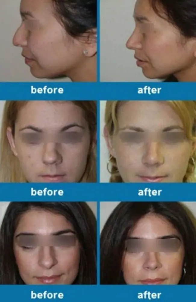 Acusnore PerfectNose Siliconen Neuslifter Acusnore PerfectNose Siliconen Neuslifter