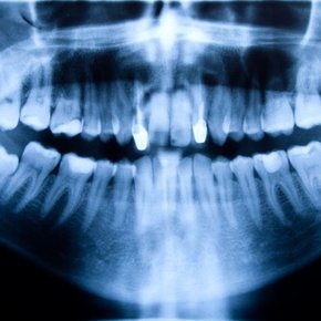 Tandenknarsen - Bruxisme