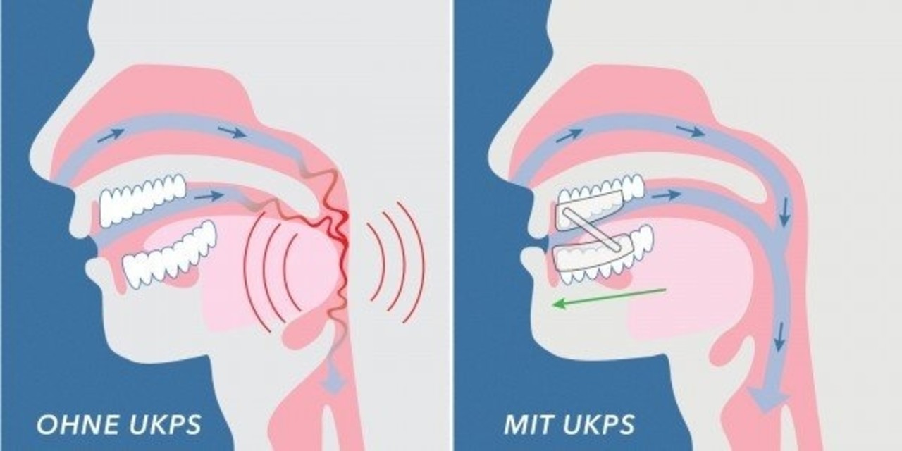 Snorflex tweedelige anti-snurkbeugel Snorflex tweedelige anti-snurkbeugel
