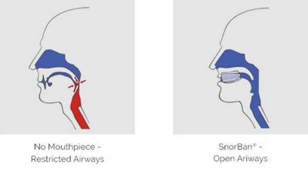 SnorBan Anti-Snurkbeugel SnorBan Anti-Snurkbeugel