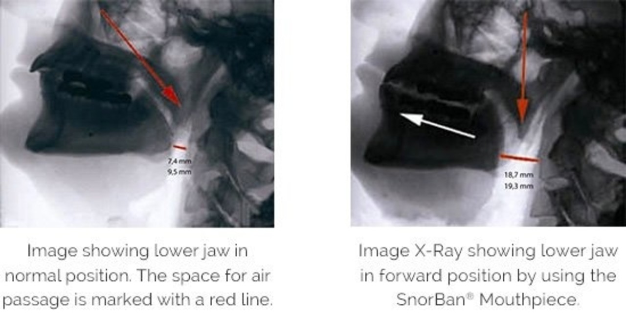 SnorBan Anti-Snurkbeugel SnorBan Anti-Snurkbeugel