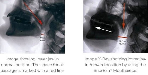 SnorBan Anti-Snurkbeugel SnorBan Anti-Snurkbeugel