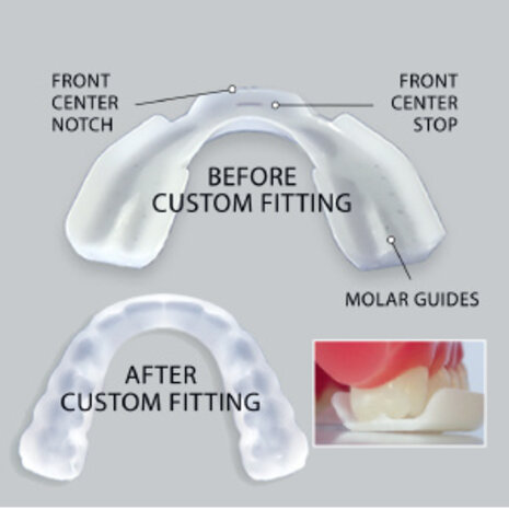 SleepRight ProRx knarsbitje op maat SleepRight ProRx knarsbitje op maat