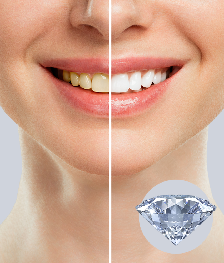 Dr. Wild Emoform Diamond tandpasta – Voor natuurlijk wittere tanden zonder schade Dr. Wild Emoform Diamond tandpasta – Voor natuurlijk wittere tanden zonder schade