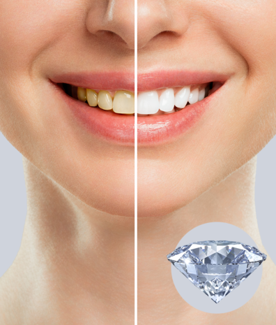 Dr. Wild Emoform Diamond tandpasta – Voor natuurlijk wittere tanden zonder schade Dr. Wild Emoform Diamond tandpasta – Voor natuurlijk wittere tanden zonder schade