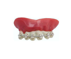 Neptanden Met Beugel | Neptanden