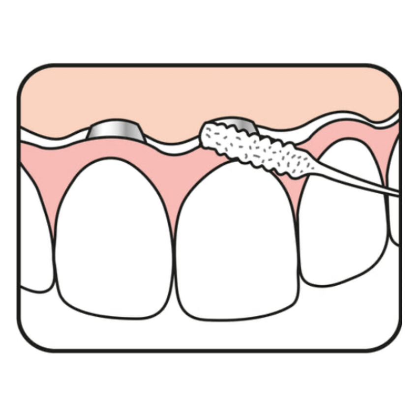 TePe Bridge & Implant Floss - 30 Stück Tepe TePe Bridge & Implant Floss - 30 Stück