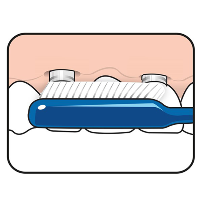 Tepe TePe Implant Orthodontic Zahnbürste