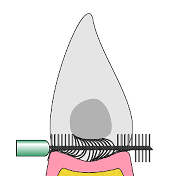 Everbright Everbright Interdentalbürsten 6,0 mm lila - 6 Stück